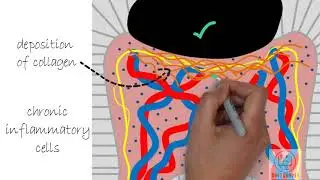 Chronic pulpitis - Diseases of pulp [Part 4]