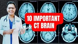10 Important CT Brain #radiology #neuroradiology