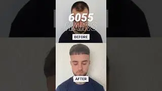 Receding hairline GONE! FUE hair transplant result! #shorts #hairpalace
