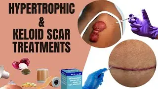 Hypertrophic & Keloid Scar Explained | Treatment Options