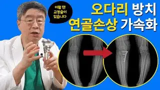 [연세사랑병원] 오다리교정, 무릎교정술(절골술) 2년 후 결과! 퇴행성관절염 시기를 늦추는 방법