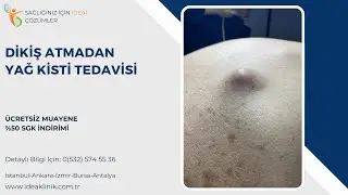 DİKİŞ ATMADAN YAĞ KİSTİ TEDAVİSİ -IDEA Klinik