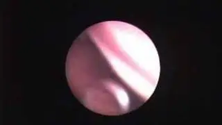 Nasal Endoscopy