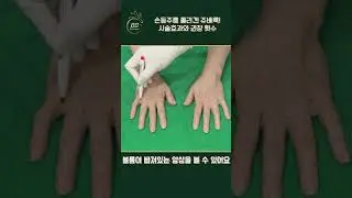 ep.74 손등주름 콜라겐 쥬베룩! 시술효과와 권장 횟수#shorts