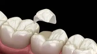 Фиксация керамической коронки с накладкой на зуб