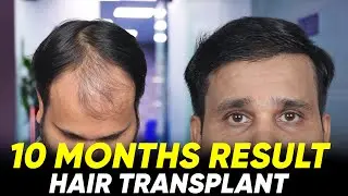 Hair Transplant in Chennai | Best Results & Cost of Hair Transplant in Chennai