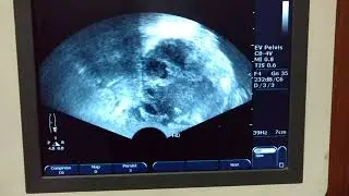 TRUS guided aspiration of prostatic abscess