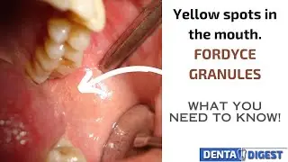 YELLOW SPOTS IN THE MOUTH. ARE FORDYCE GRANULES DANGEROUS?