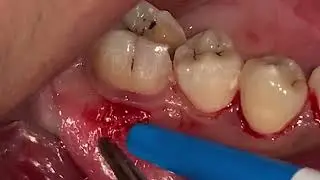 How to Burst Tooth Abscess