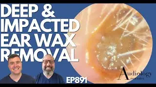 DEEP & IMPACTED EAR WAX REMOVAL - EP891