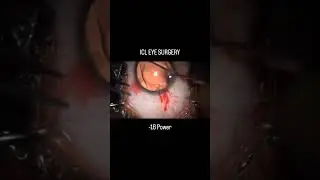 ICL Eye Surgery!!! 