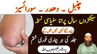 How To Cure Psoriasis Permanently l Chambal Ka Gharelu Ilaj By Hakeem Habib Ullah New Video