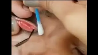 Satysfying of removing the caterpillar in the eye