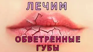 Как лечить обветренные губы? Быстро восстанавливаем кожу губ