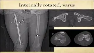 Tips for avoiding malreduction with subtrochanteric femur fractures