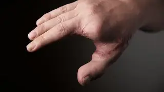 Chris’ Story