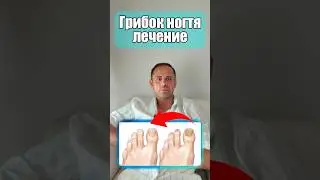 Лечение грибка ногтя 💥