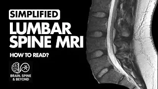 How to Read a Lumbar Spine MRI Scan?