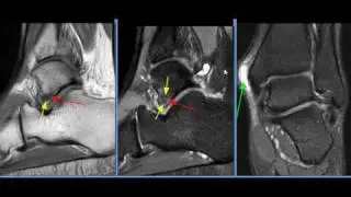 MRI Ankle Case 23