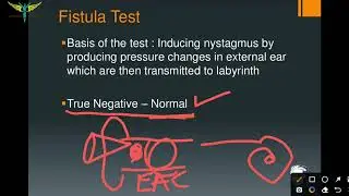 Fistula test - ENT | Tests for Vestibular functions