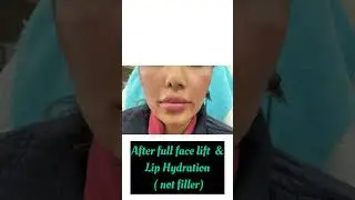 Before & After full face lift & lip Hydration | Dr Ashima Goel| Dermatologist in chandigarh| Mohali
