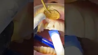 Removing Veneers with the Lite Touch Laser #litetouch #dentist #veneers