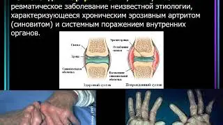Дифференциальная диагностика суставного синдрома