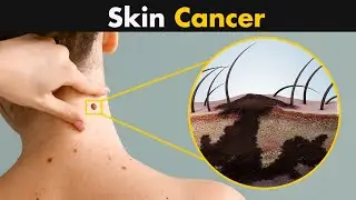 What Happens In Skin Cancer? | Symptoms, Causes and Treatment (Urdu/Hindi)