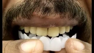 Clip On Veneers!!
