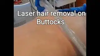Anus Hair? Remove Them With Laser!