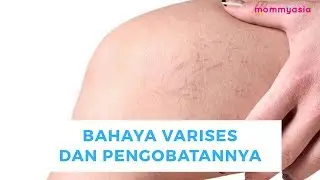Waspada, Ini Dia Bahaya Varises dan Cara Pengobatannya Yang Wajib Tahu!