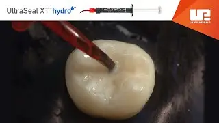 Video de procedimiento de UltraSeal XT hydro, de Ultradent