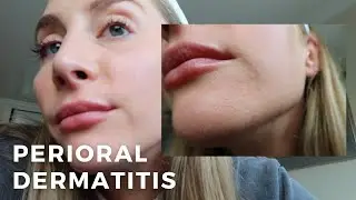 Perioral Dermatitis (What to Know, Skincare + An Esthetician's Experience.)