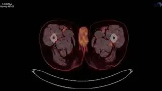 PSMA PET/CT F-18 Pylarify Case 6