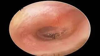 A flying insect stubbornly stuck over the eardrum