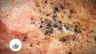 Most Satisfying Close-Up Blackhead Removal 2024