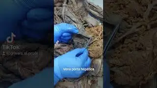 La vena porta hepática