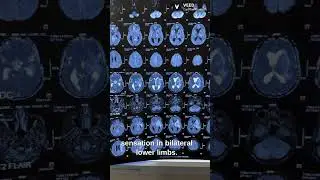 MRI brain case discussion  #mrcp #medicalstudent #medicaleducation #neetpg
