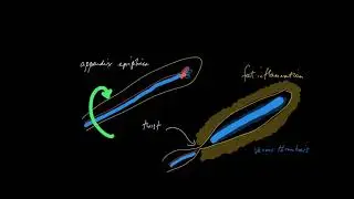 Epiploic appendagitis: what the heck is that?
