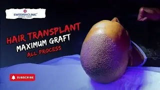 The Surprising Truth About İsveç Kliniği Hair Transplant Nobody Tells You