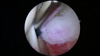 Rotator Cuff Repair and Mumford distal clavicle excision 4 27 23 KA