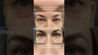 Круговая блефаропластика - убрали нависание верхних век и мешки под глазами