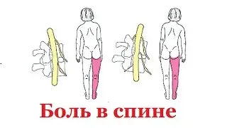 Боль вспине