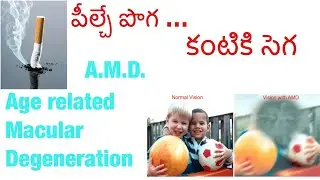 పొగ తాగడం వల్ల కంటి చూపు దెబ్బతింటుంది/smoking-eye damage/A.M.D/age related macular degeneration