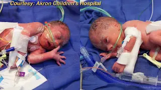 Twins born with spina bifida (WEWS)