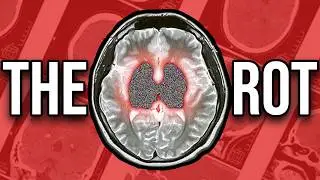 Brain Rot Has To Stop.