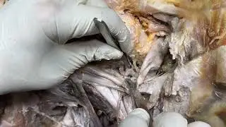ROOT OF NECK SUBCLAVIAN Artery PHRENIC VAGUS RECURRENT LARYNGEAL Nerves DOLICHOECTASIA–Sanjoy Sanyal