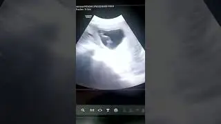 13 ҳафталик ҳомила. 3D кўриниши билан.