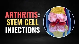 Why Stem Cell Treatments for Knee Arthritis Might Not Work