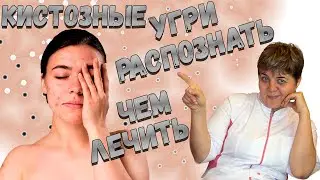 🔴 Угри кистозные  ✅ избавиться от них раз и навсегда